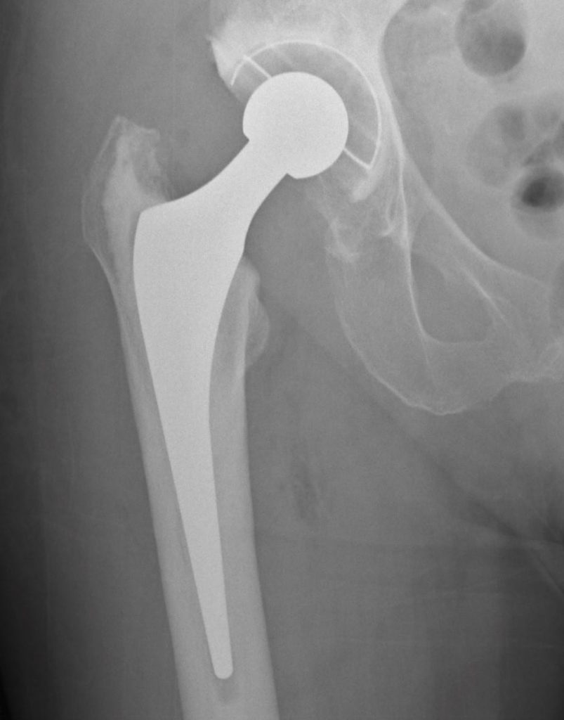 Implant Choice More Important Than Surgeon Skill For Hip Replacement 